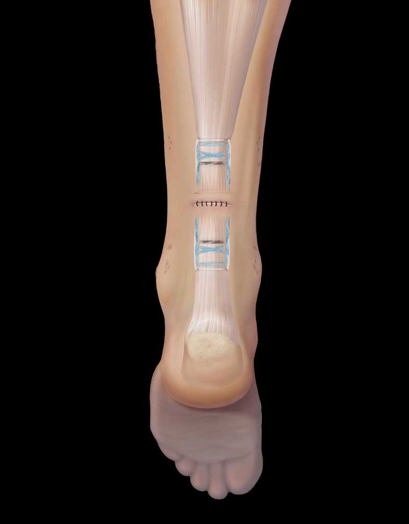 Achilles tendon repair